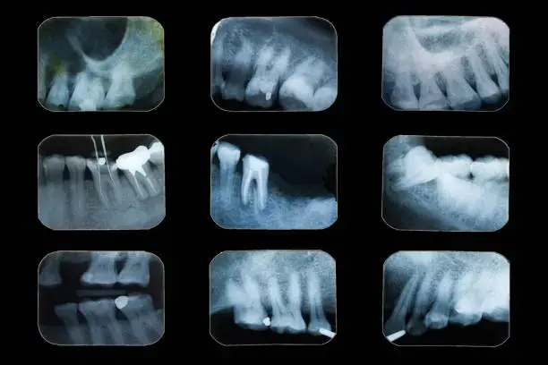 Grid of dental X-rays showing teeth, roots, and fillings for dental radiology in Montville, NJ