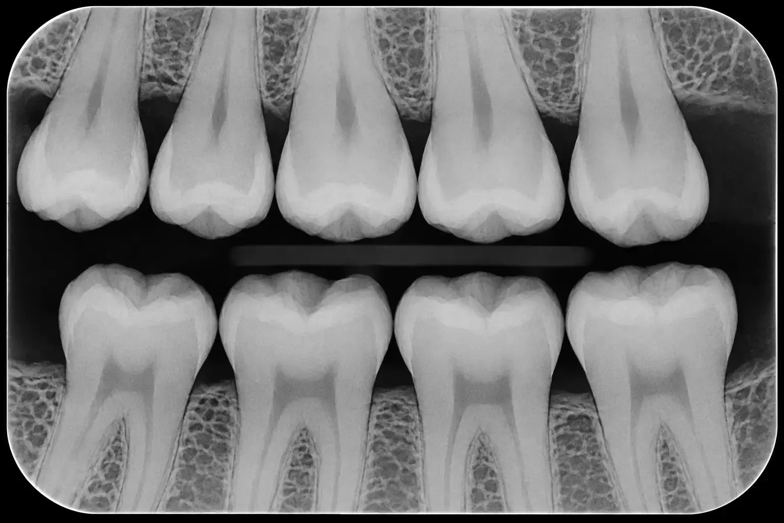 Bitewing X rays in Montville, NJ