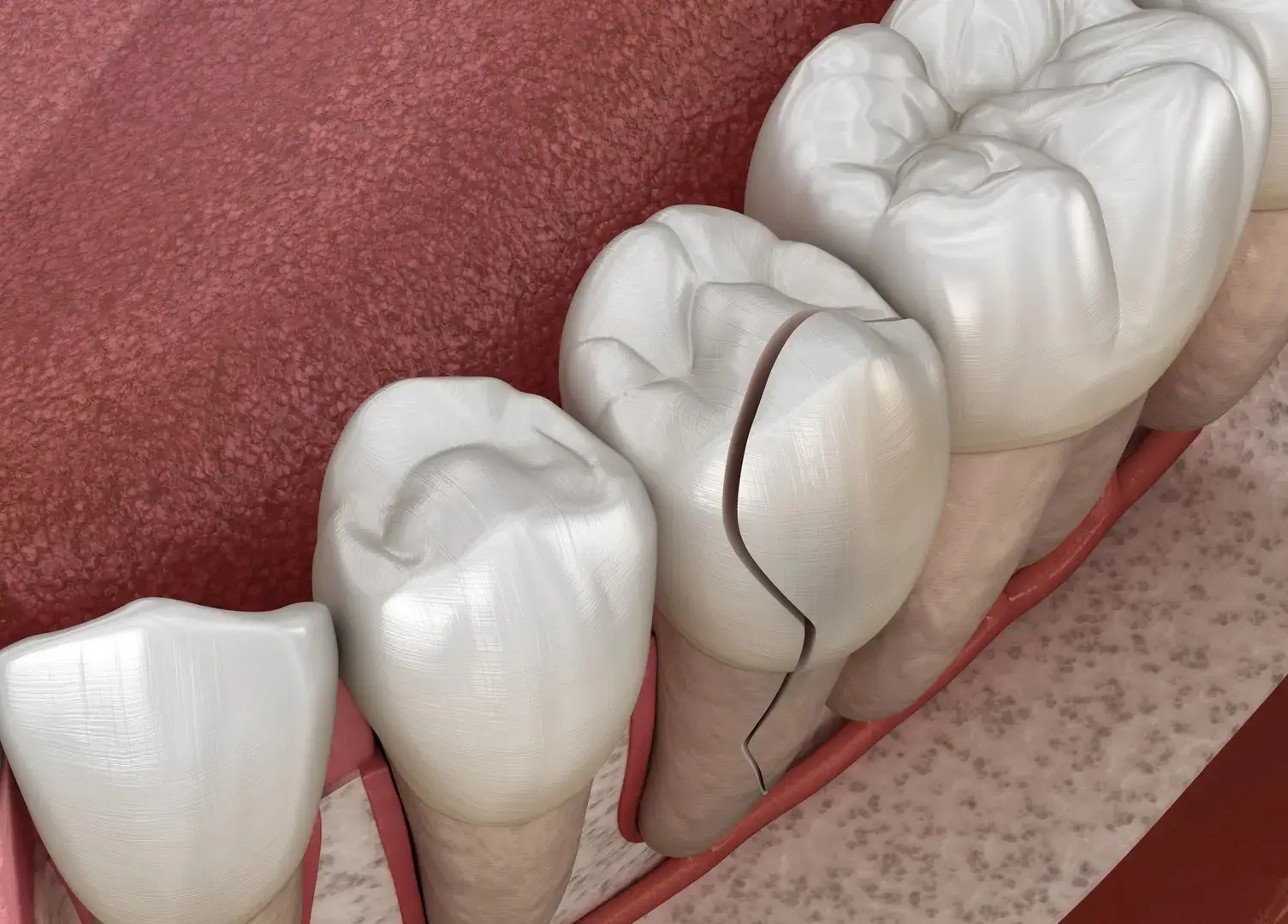 3D illustration of a cracked molar showing a split crown and root