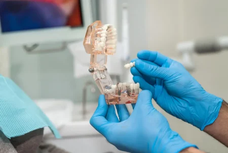 Dental Bridges in Montville, NJ to Fill the Gap With Confidence Dental Bridges in Montville, NJ