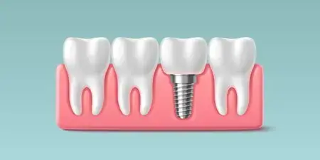 Dental Implant Crowns in Montville, NJ That Look and Feel Real Illustration of a dental implant crown on a titanium post between natural teeth in Montville, NJ