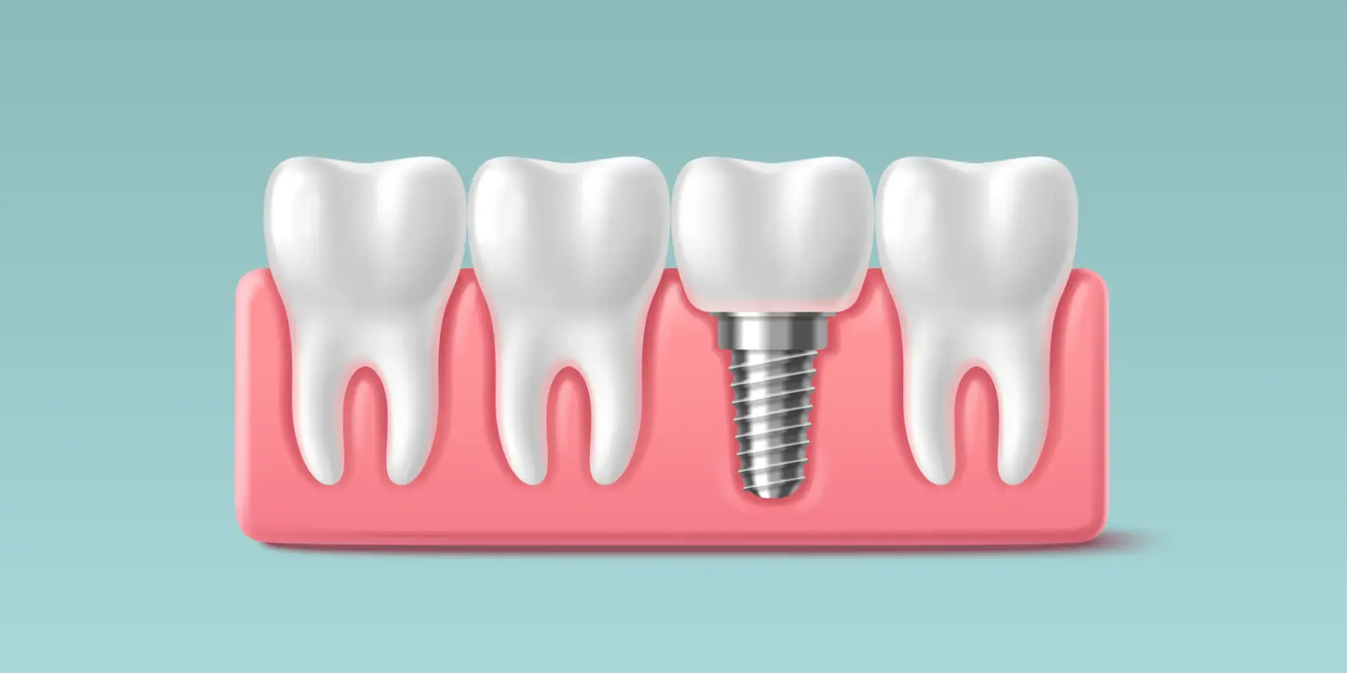 Dental Implant Crowns