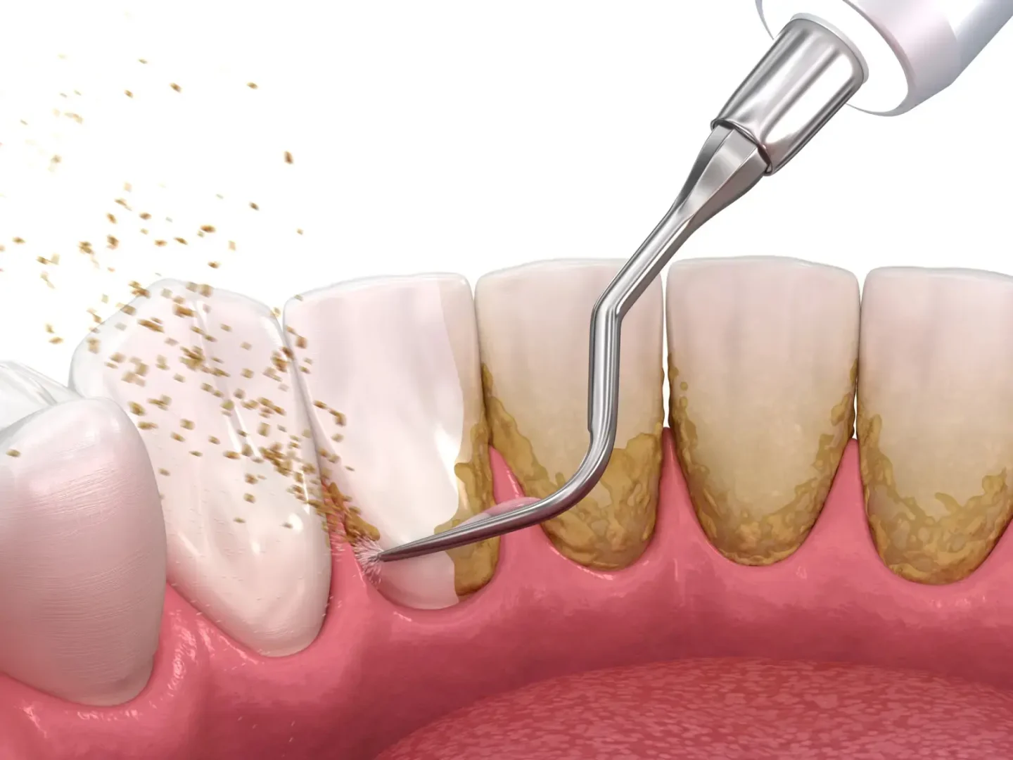 Removal of Plaque and Tartar in Montville, NJ